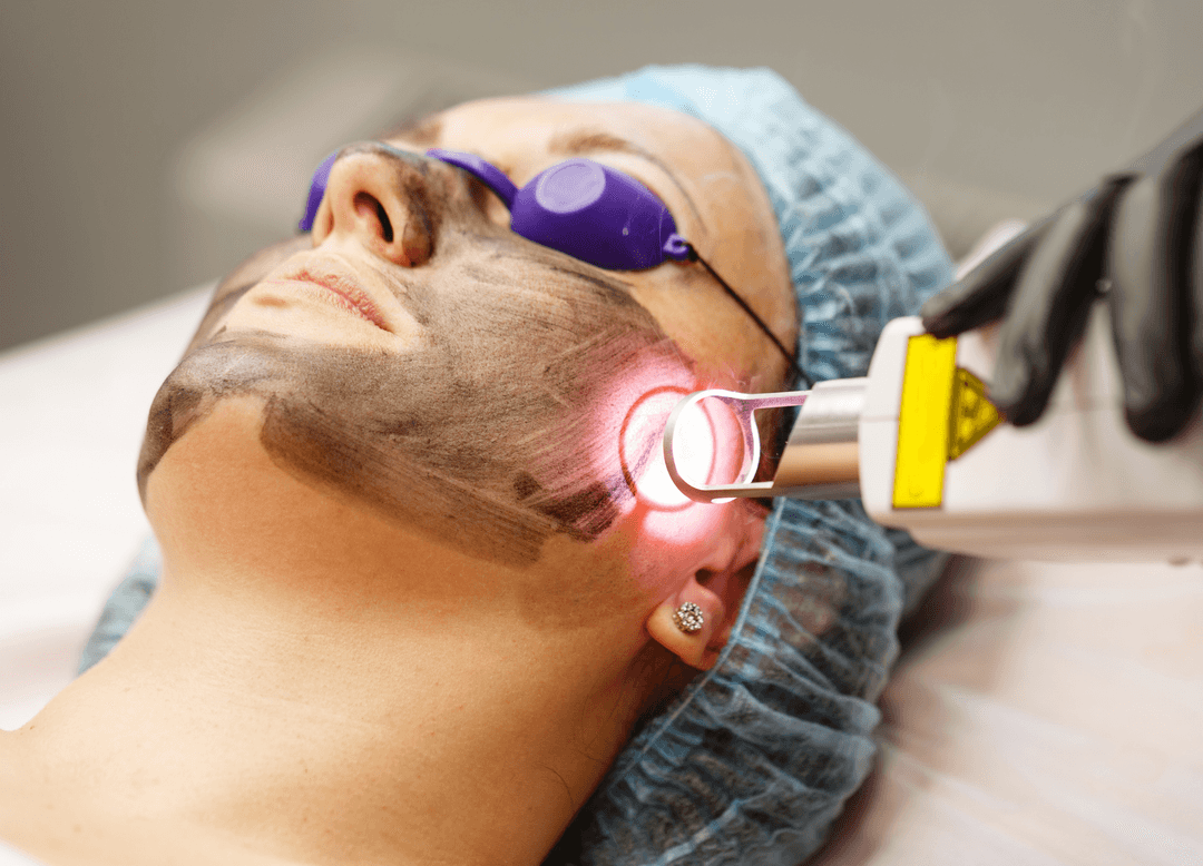 Carbon Laser Peel
